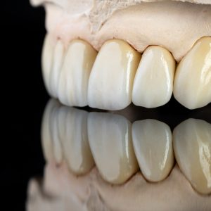 Dental health care. Ceramic zirconium in final version. Close up dental zircon ceramic crowns on black background